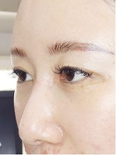 이마거상 실리프팅