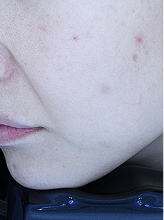 피코슈어플러스+엑셀브이+줌패스