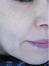 피코슈어+엑셀브이