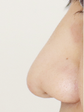 코필러+코실리프팅