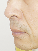 팔자필러+볼륨실