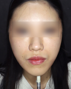 실리프팅