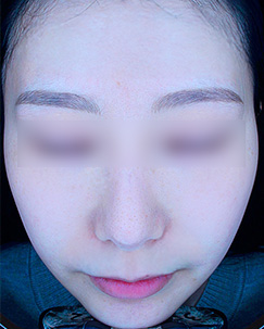 색소토닝