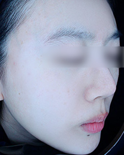 색소토닝2